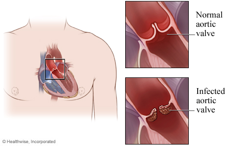 HVIendocarditis.jpg